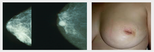 Κακοήθεις Όγκοι του Μαστού - Καρκίνος Μαστού
